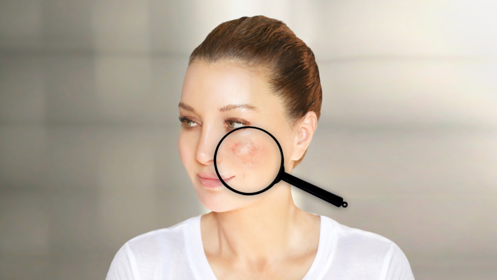 NDDA Rosacea and Facial Redness NDDA Rosacea and Facial Redness