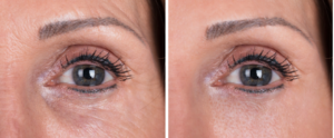 NDDA March 2023 Blog Image Ultherapy