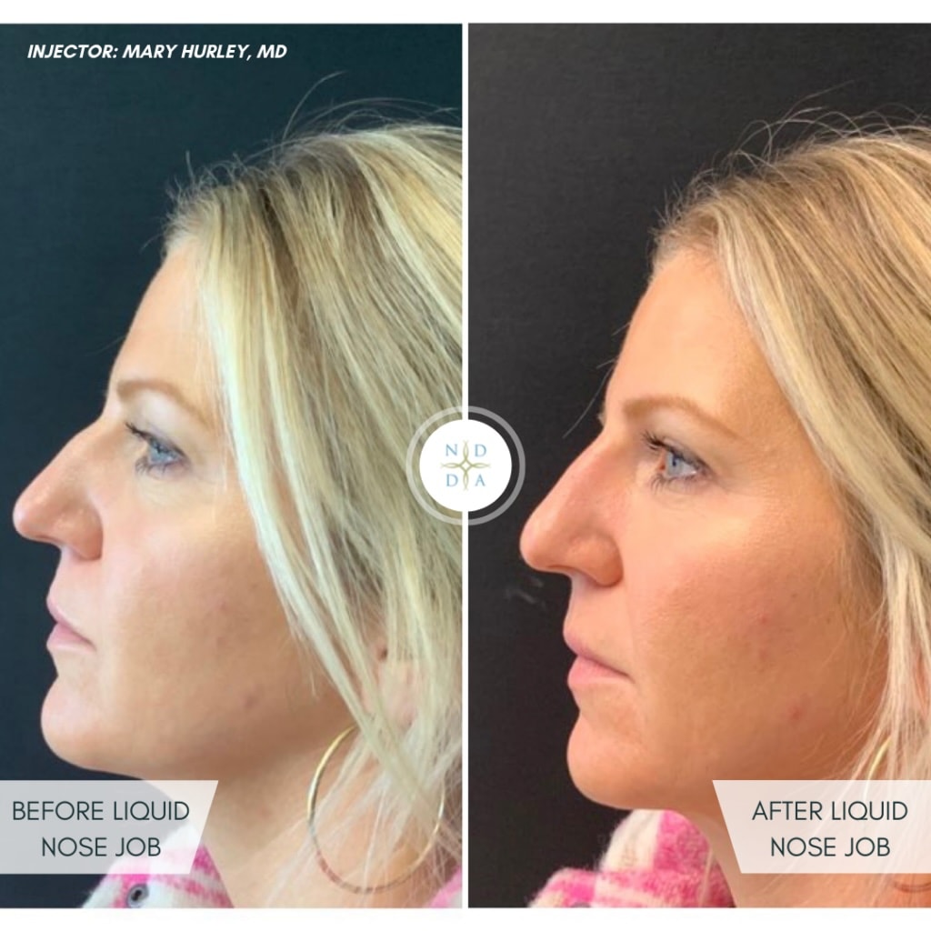 Mary Hurley, MD - Rhinoplasty