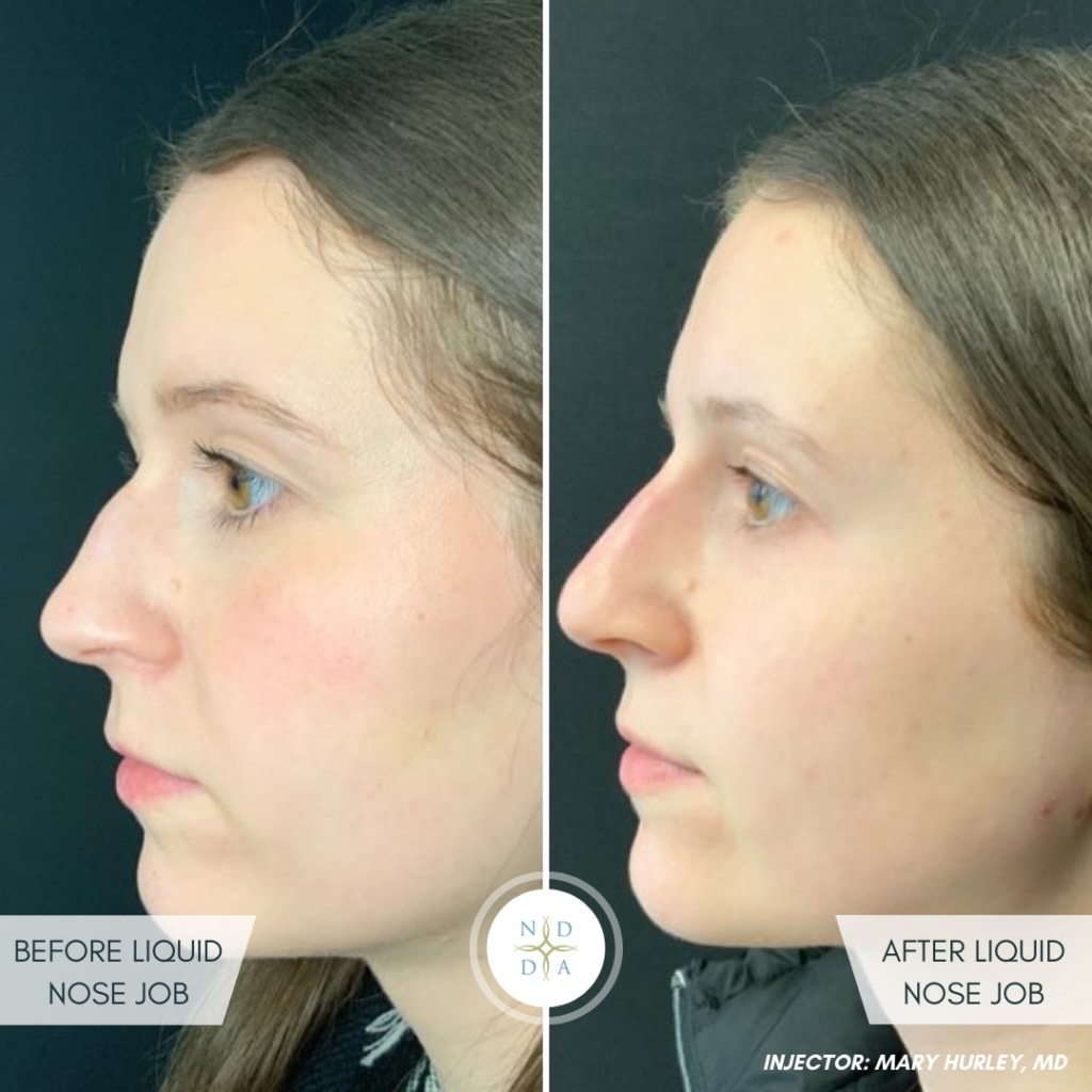 Mary Hurley, MD - Rhinoplasty