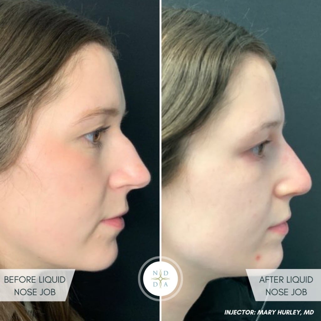 Mary Hurley, MD - Rhinoplasty