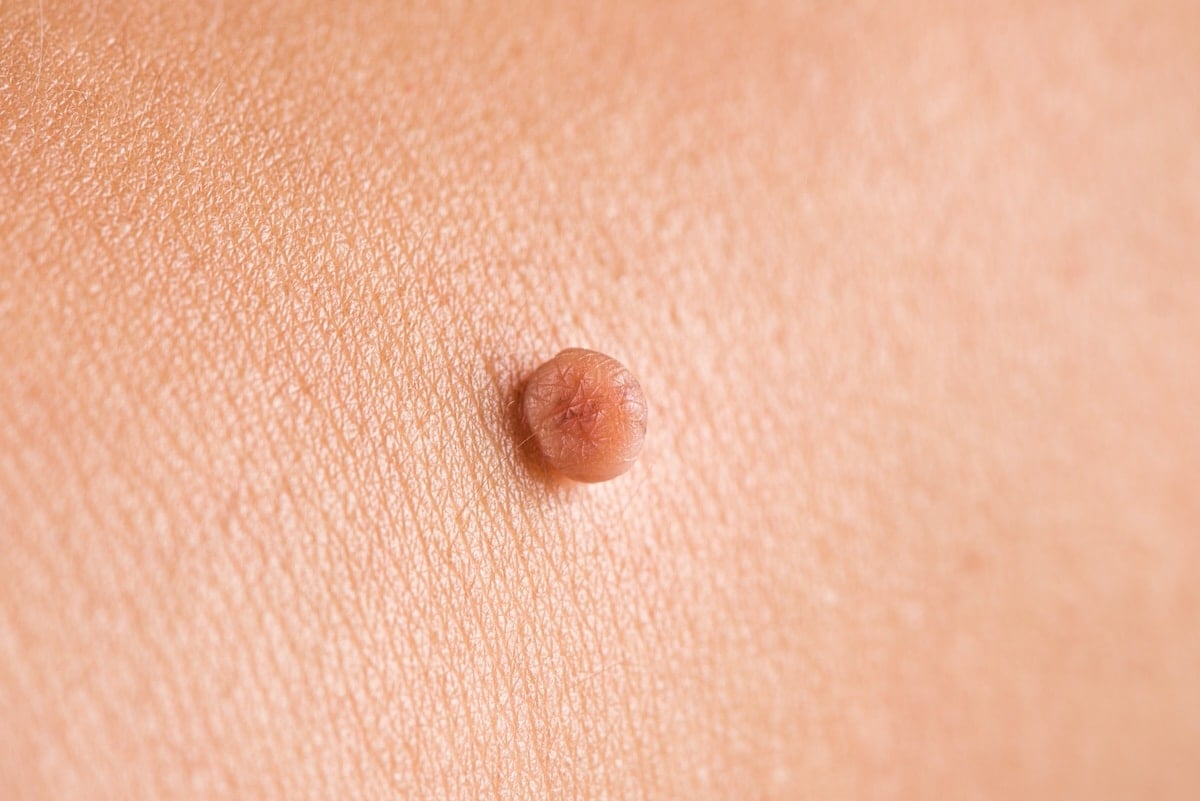 Kin Tag Liquid Nitro Liquid Nitrogen On Skin Tags