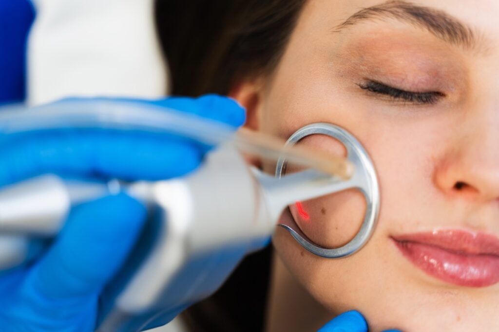 CO2 Laser Treatment